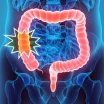 colorectal cancer