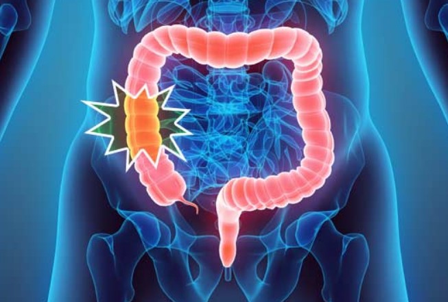 colorectal cancer