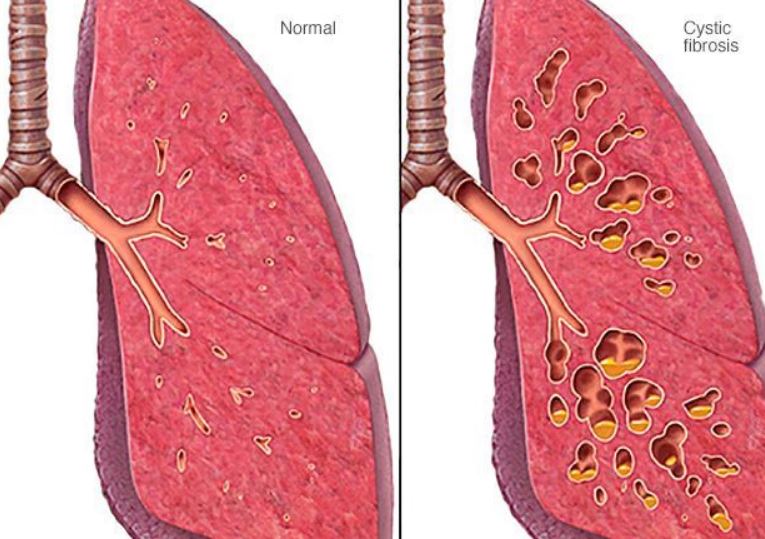 cystic fibrosis