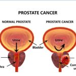 prostate cancer