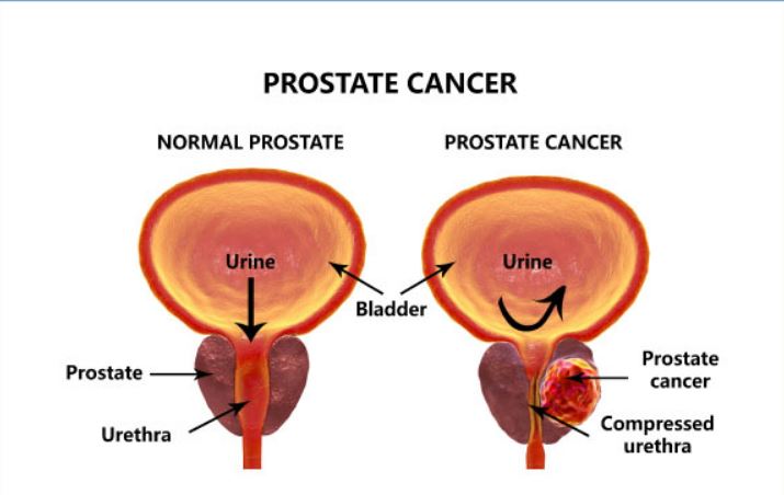 prostate cancer